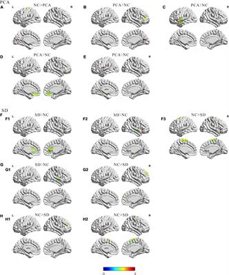 Characterizing Differences in Functional Connectivity Between Posterior Cortical Atrophy and Semantic Dementia by Seed-Based Approach